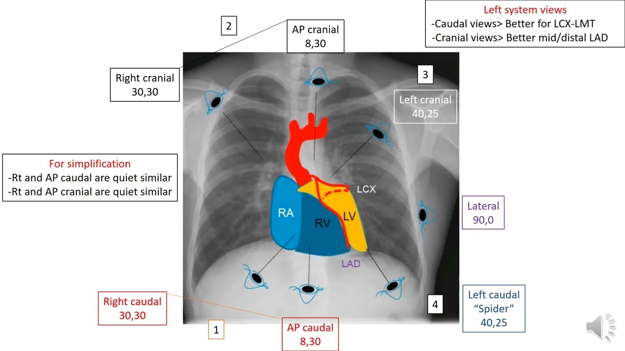 How to read  a coronary angiography