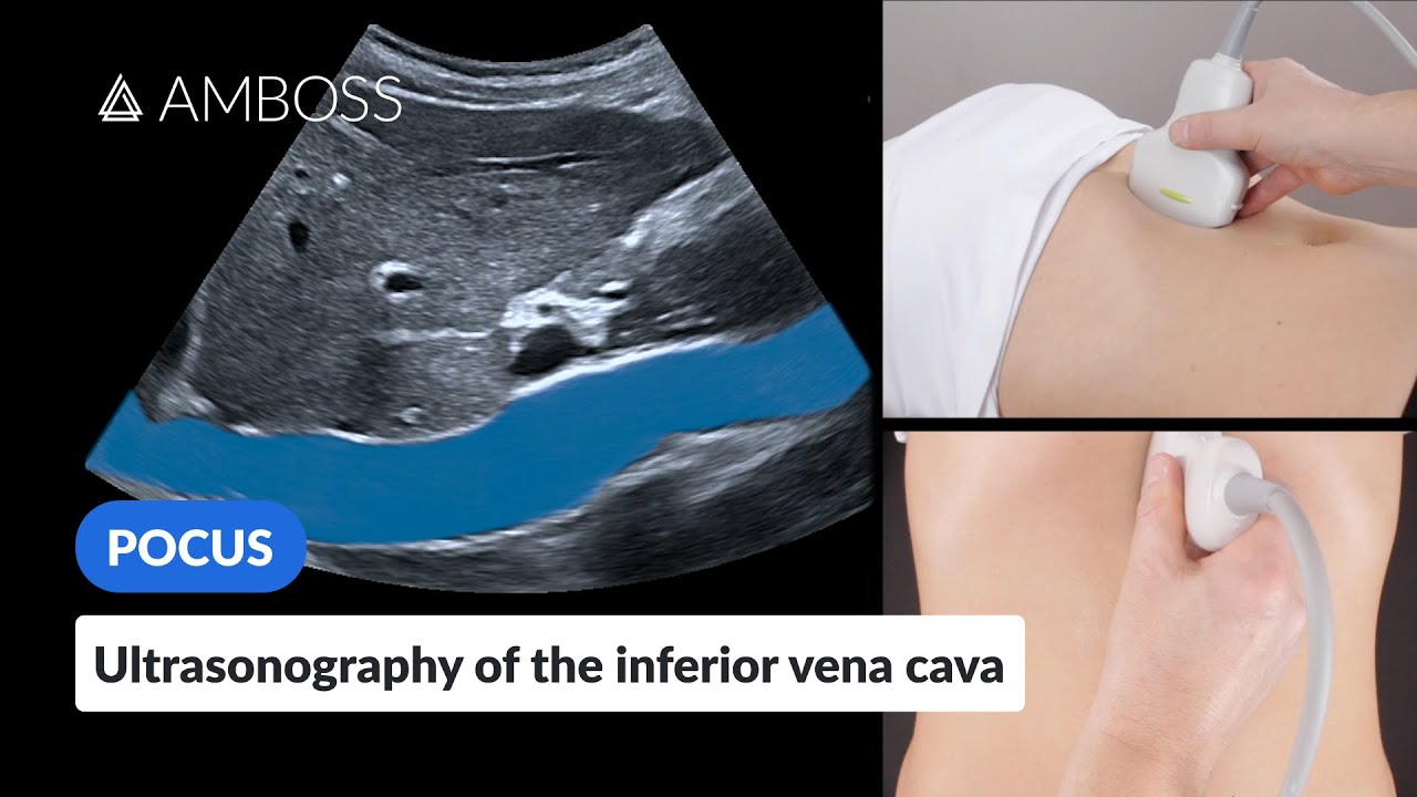 Point of Care Ultrasound of the Inferior Vena Cava (IVC) - AMBOSS Video