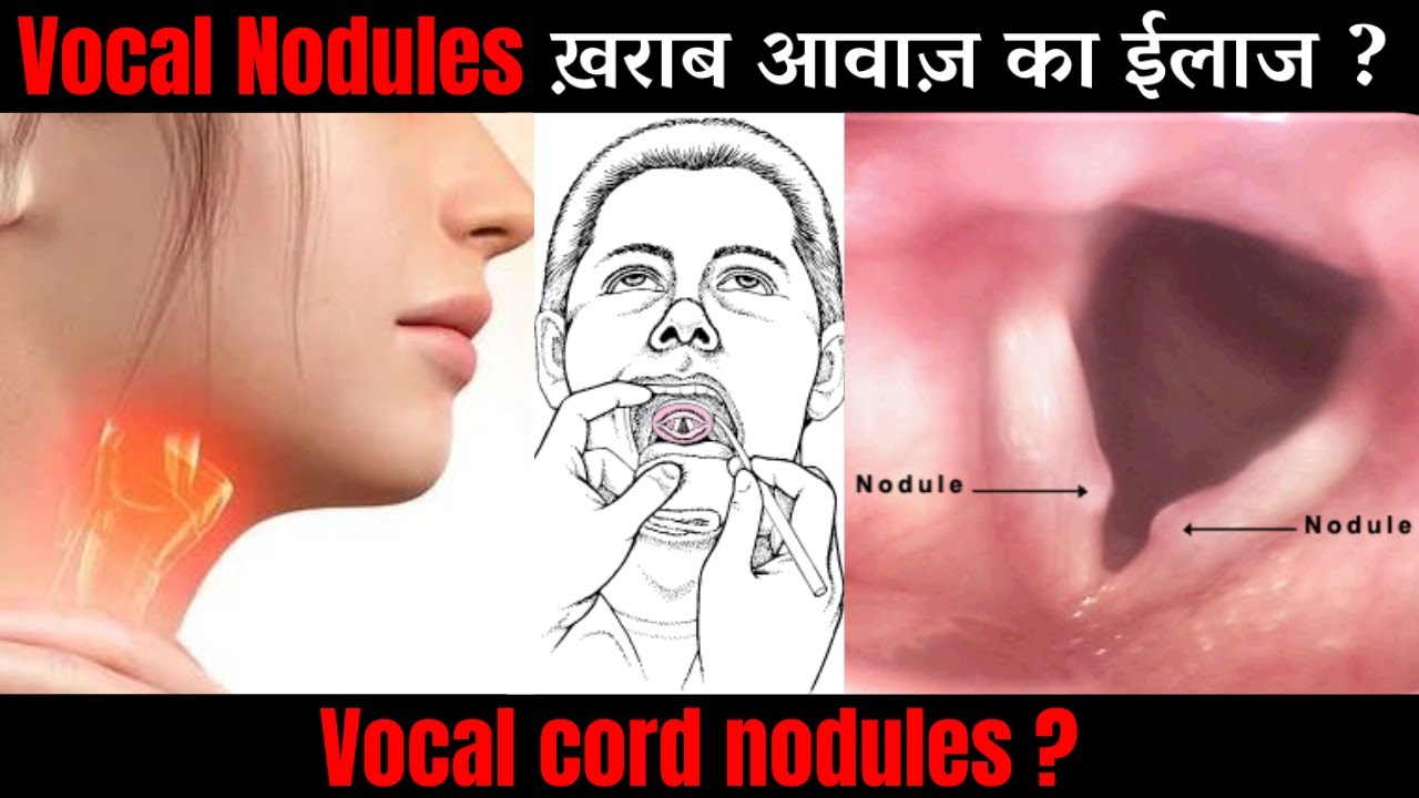 Vocal Nodules | Hoarse Voice | ख़राब आवाज़ का ईलाज। Dr Sunil Tanvar