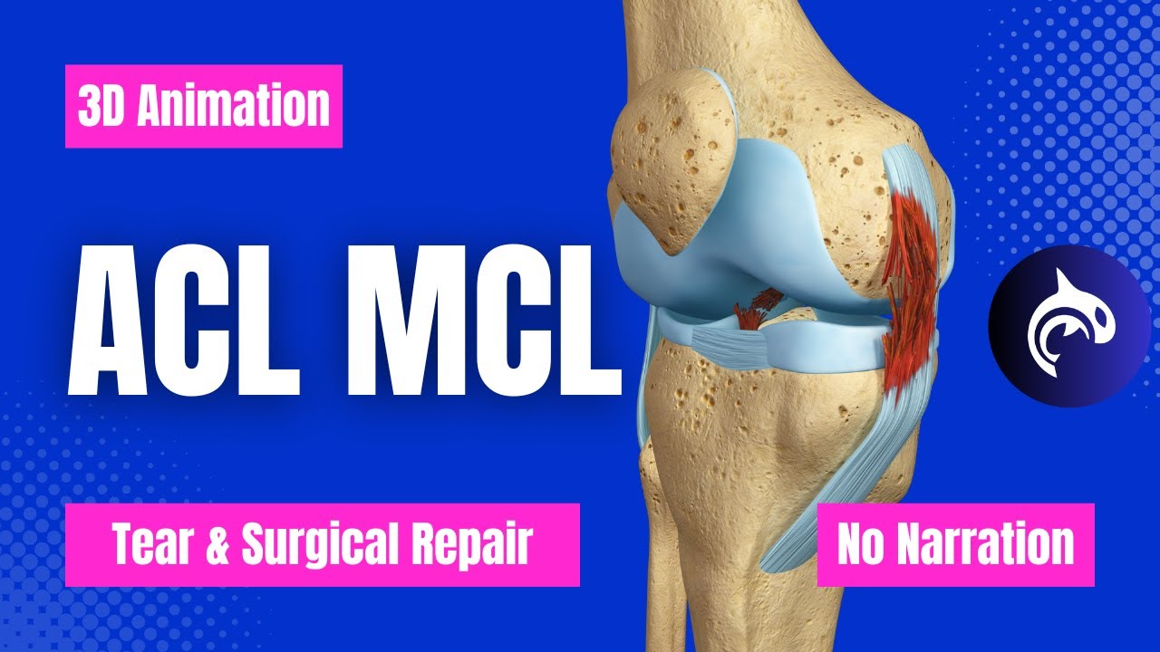 ACL (Anterior Cruciate Ligament) MCL (Medial Collateral Ligament) Tear and Repair (No Narration)
