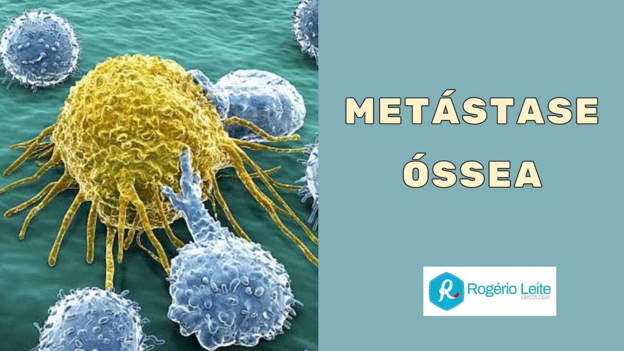 Metastase Ossea Sintomas Iniciais [Dr. Rogério Leite]