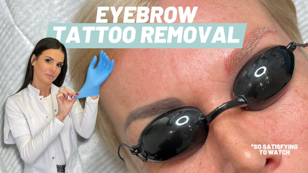 Eyebrow laser tattoo removal - with the pico laser l PMU REMOVAL
