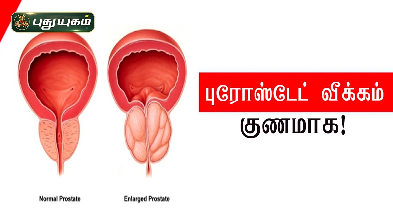 புரோஸ்டேட் வீக்கம் குணமாக! Dr. N.R. Jayakumar | PuthuyugamTV