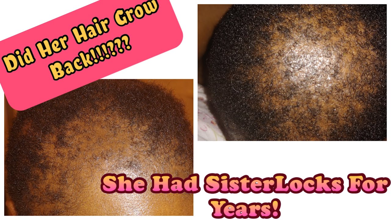I Had SisterLocks For 14 Years!! Did Her Hair Grow Back??? (BlackHairandSkincare.com)