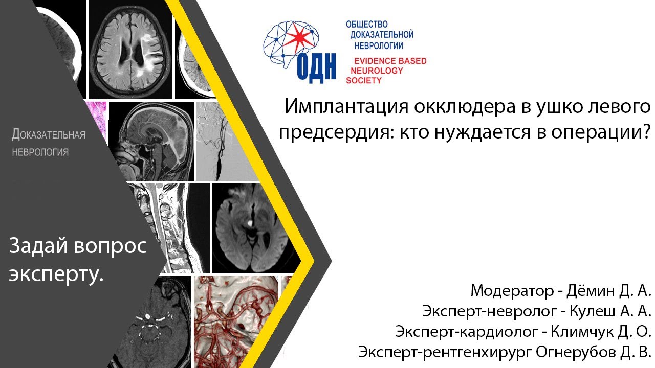 Имплантация окклюдера в ушко левого предсердия: кто нуждается в операции?