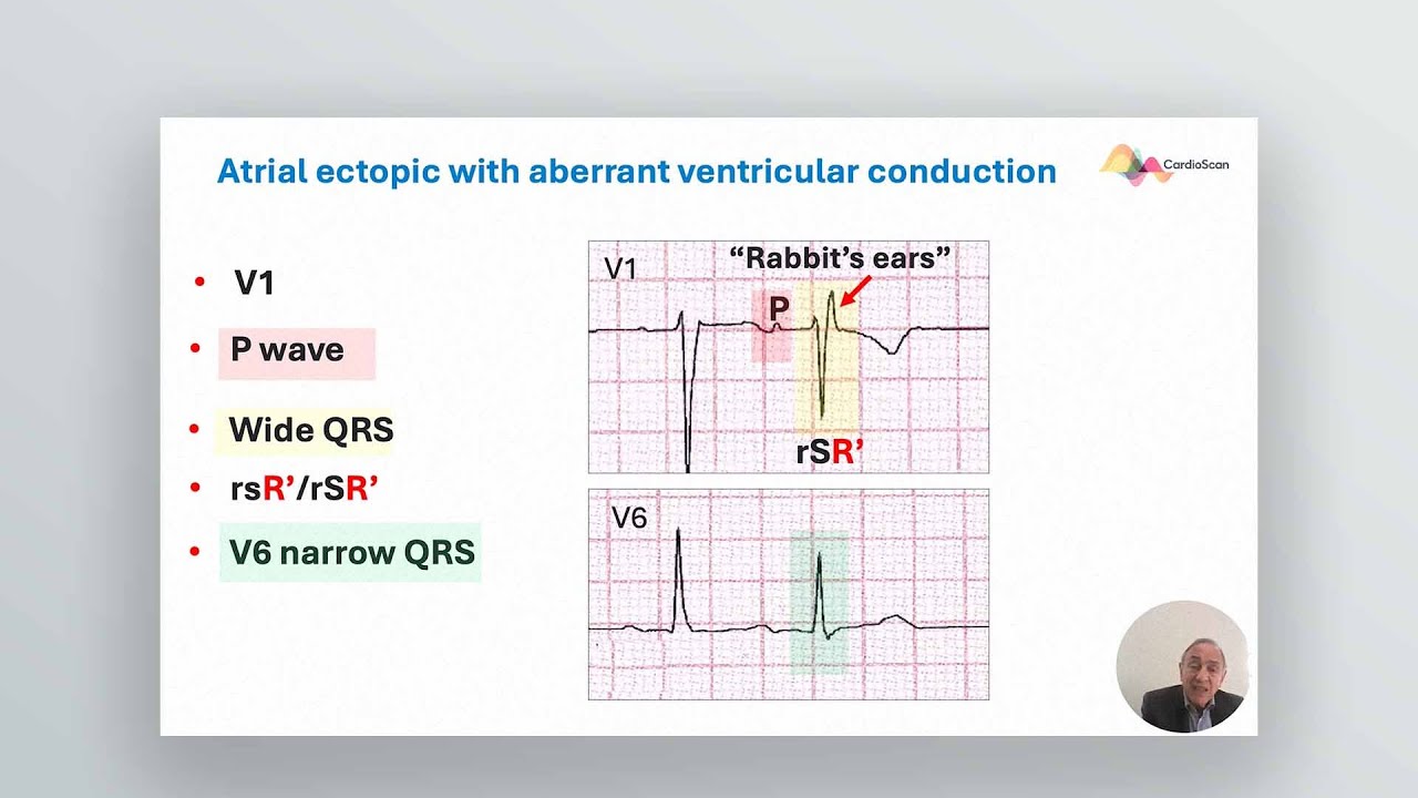 Masterclasses in Electrocardiography - Lecture 1: The Footprints ofAberrant Ventricular Conduction