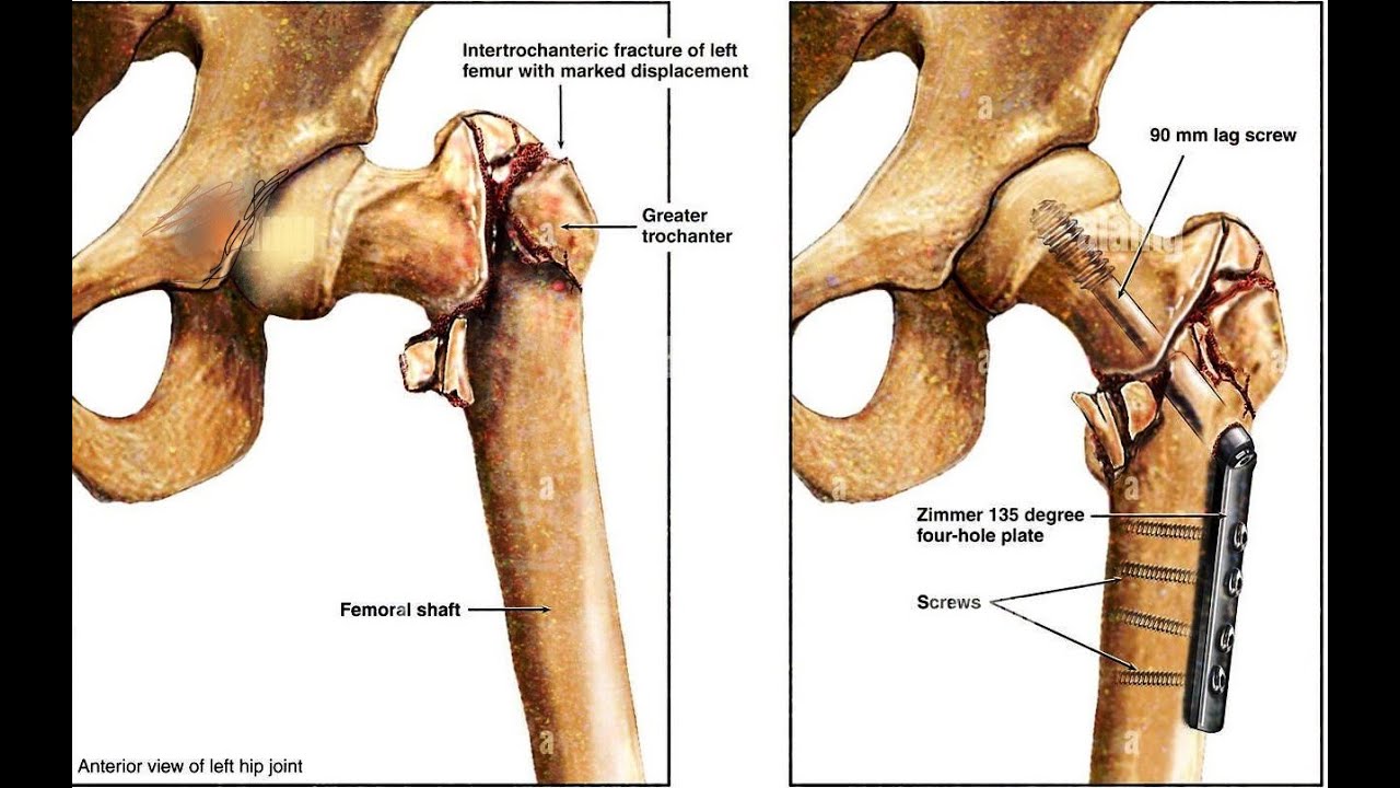 Intertrochanteric  Fractures
