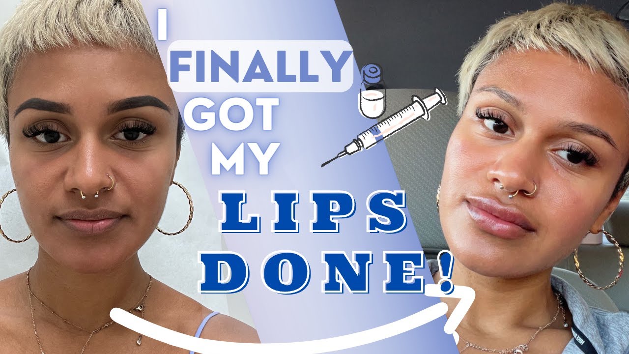GETTING LIP FILLERS FOR THE FIRST TIME | MIAMI | VLOG 17