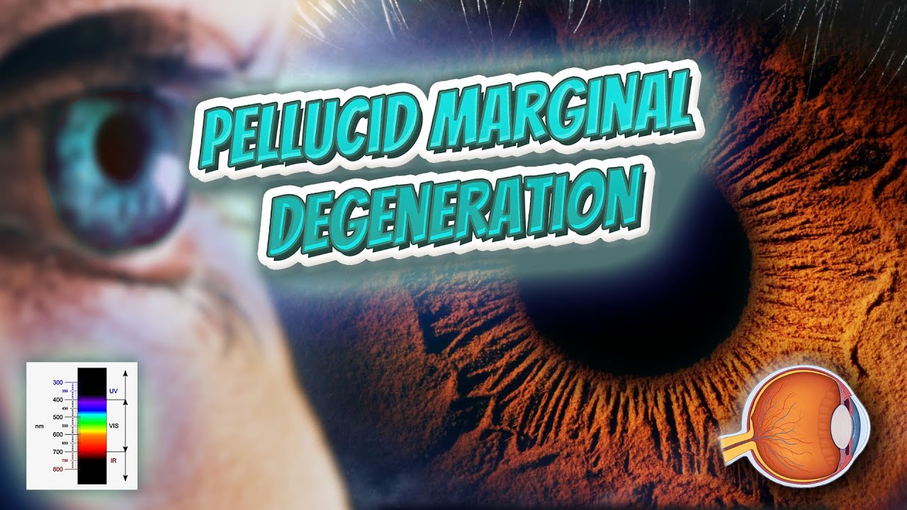 Pellucid marginal degeneration - Your EYEBALLS - EYNTK 👁️👁️💉😳💊🔊💯✅