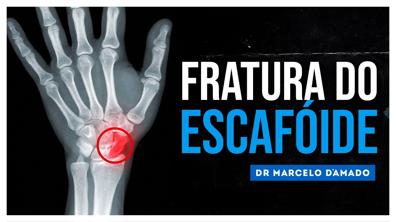 FRATURA DO ESCAFÓIDE | OSSO QUE FICA NO PUNHO | SAIBA O QUE É