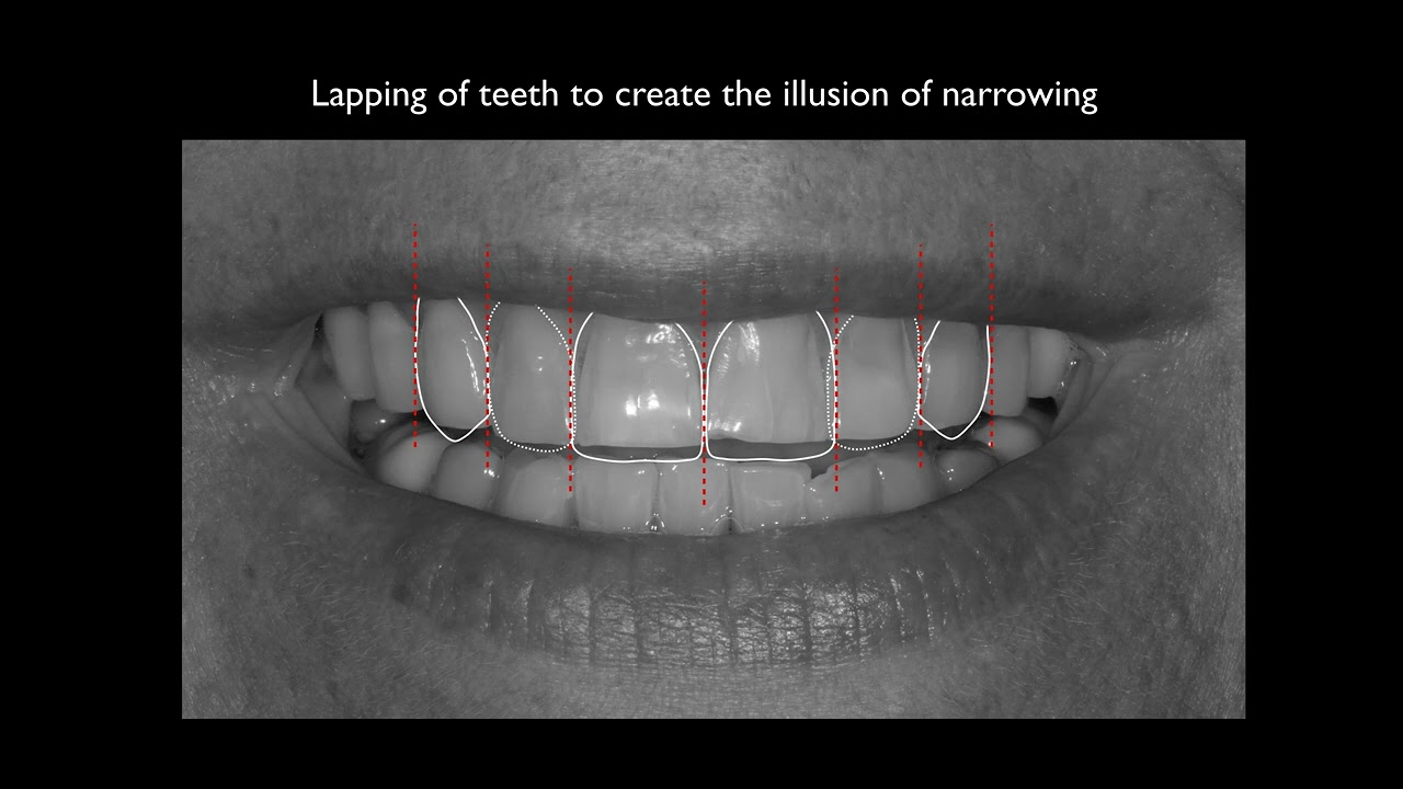 Things to consider when doing anterior restorative dentistry