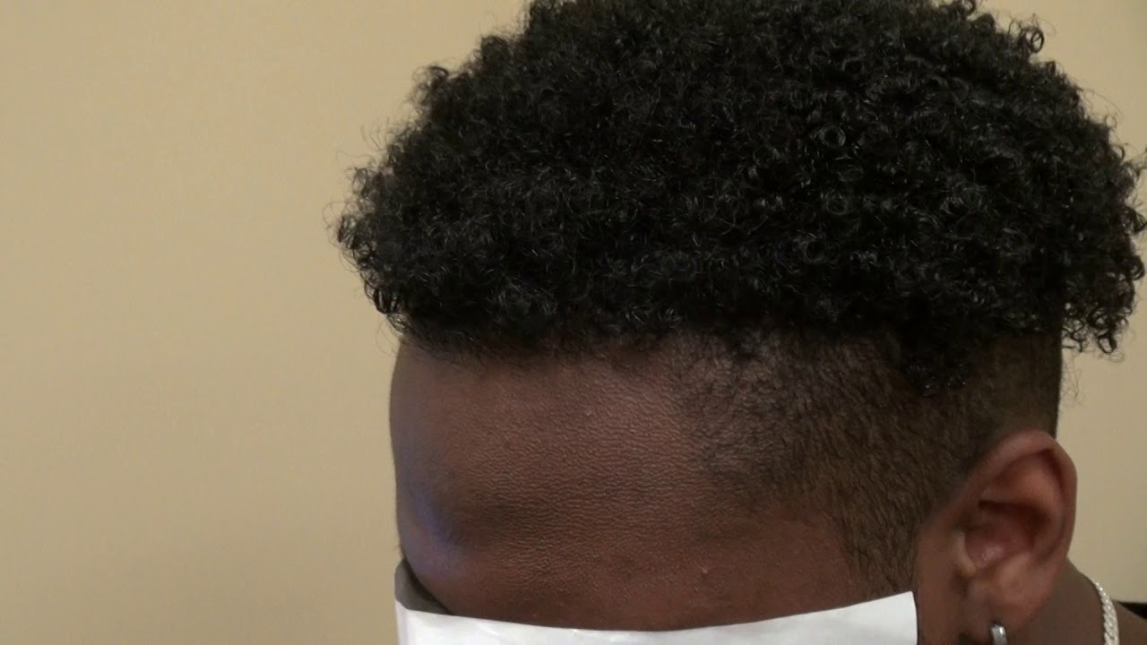Black Hairline Lowering Hair Transplant Hairline Restoration Surgery Dr. Diep Bald Hair Loss
