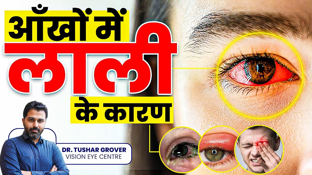 आंखों में लाली के कारण | Causes of Redness in Eyes