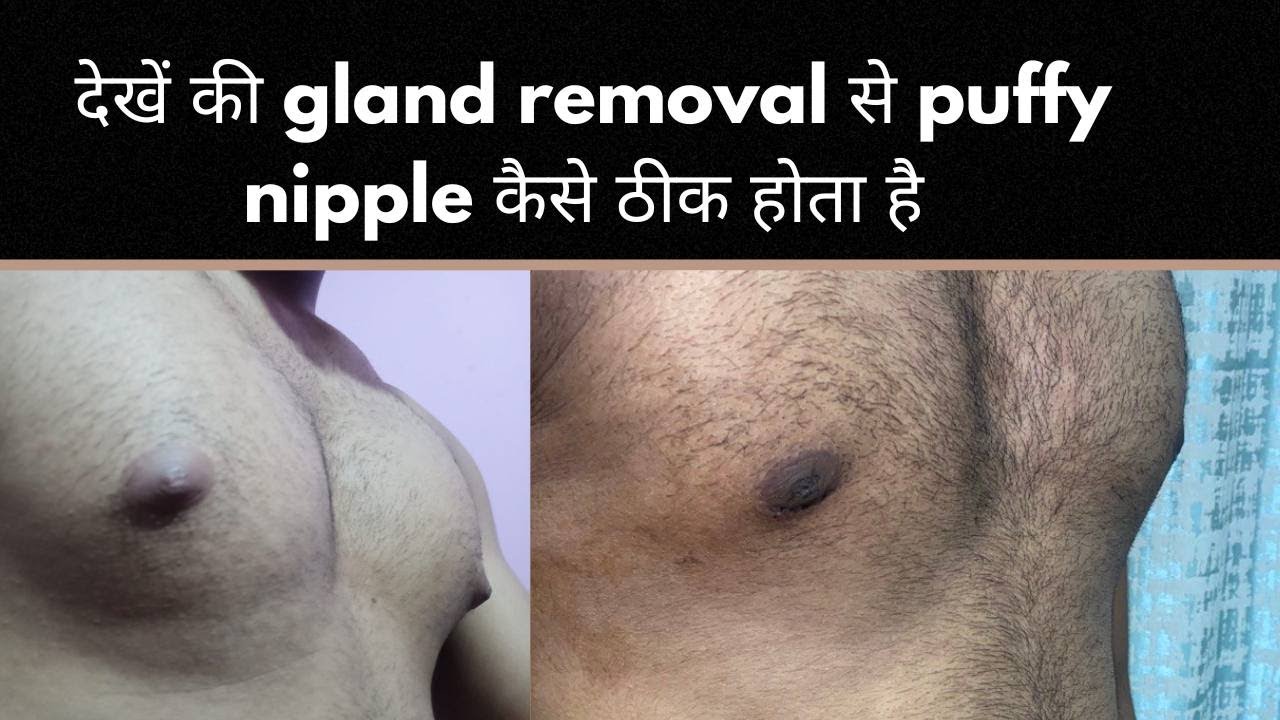 Puffy nipple disappears with gland removal:Puffy nipple से छुटकारा gland removal द्वारा Dr.SKGulati