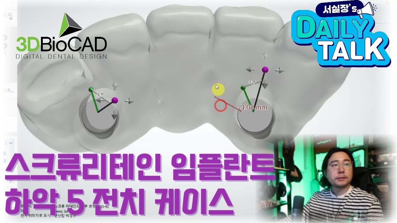 서실장's DAILY TALK - 스크류리테인 임플란트 하악 5전치 디자인 (Screw Retained implant lower 5 unit bridge)