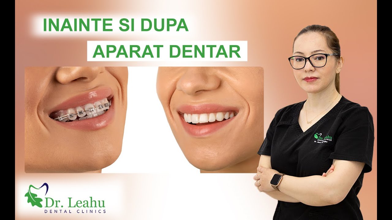 Indreptarea dintilor cu aparat dentar, inainte si dupa - Clinicile Dentare Dr. Leahu