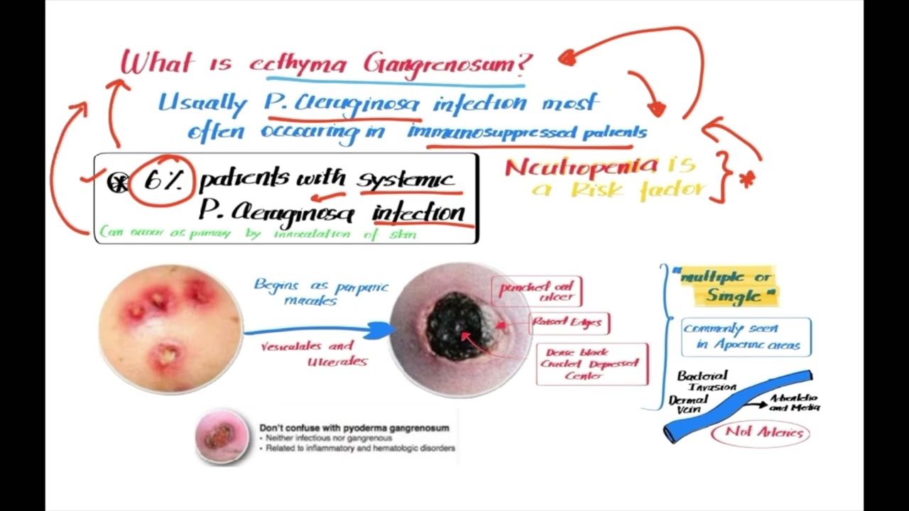 Ecthyma - Part 2 skin infection
