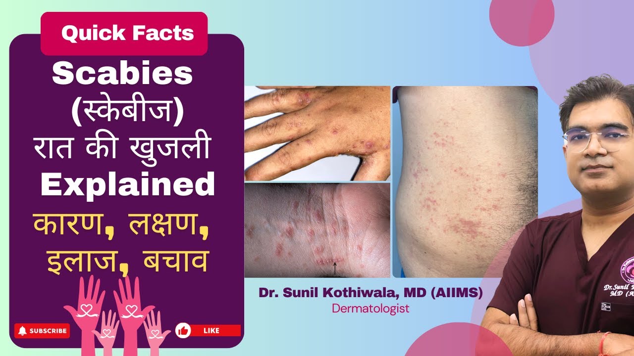 Scabies Treatment, Causes, Symptoms | स्केबीज क्या है, स्केबीज का इलाज | रात की खुजली का घरेलू इलाज