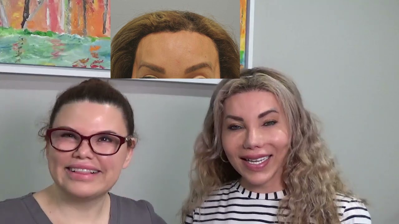 Creating a feminine hairline in transgender patients, how we do it, interview with patient at 7 year