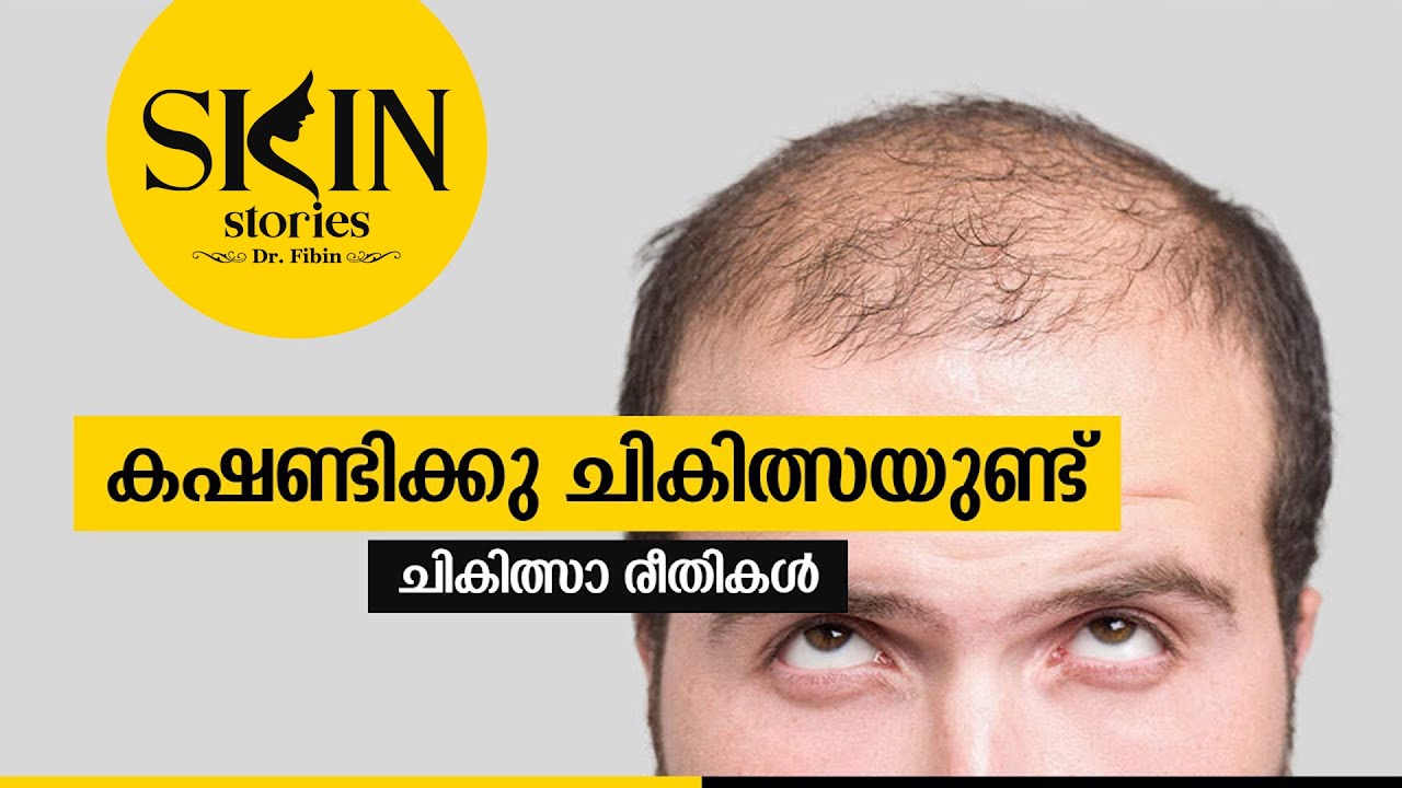 കഷണ്ടിക്ക് ചികിത്സയുണ്ട്  | All About Male Pattern Hair Loss | Dr. Fibin | Skin Stories #09