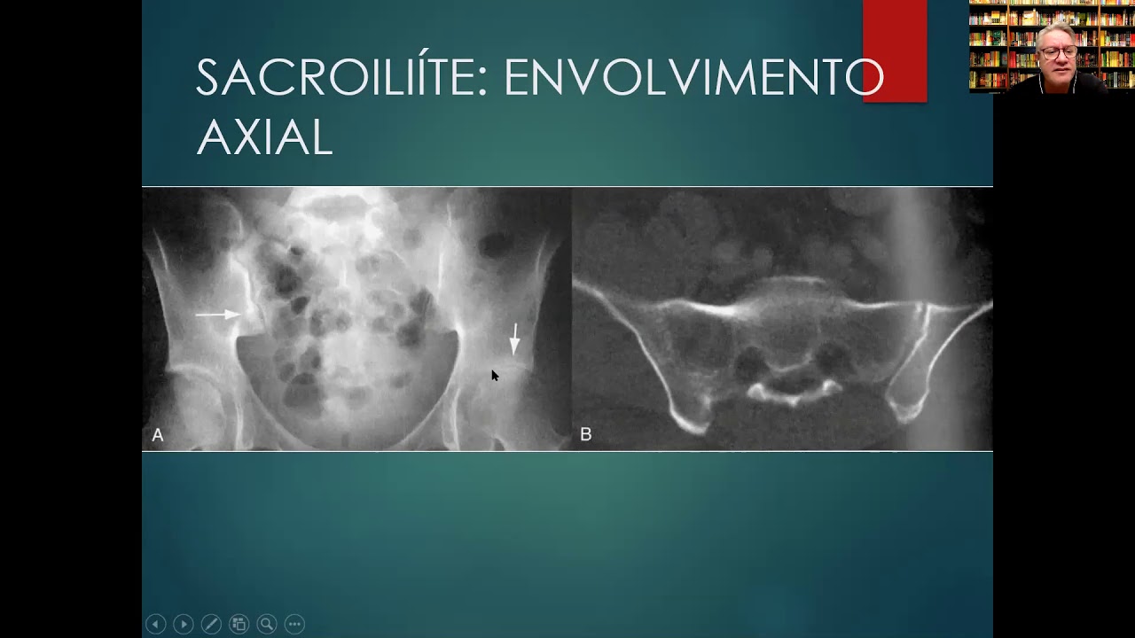Conceito e Classificação das Espondiloartrites- Prof Valderilio Feijó Azevedo