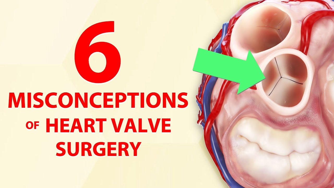 Patient Webinar: 6 Misconceptions of Heart Valve Surgery