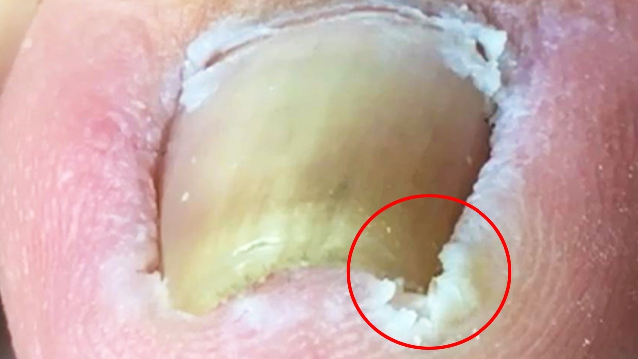 Inflamed, Curled Nails That Dig Deep Into The Toes【Crazy pedicure room】