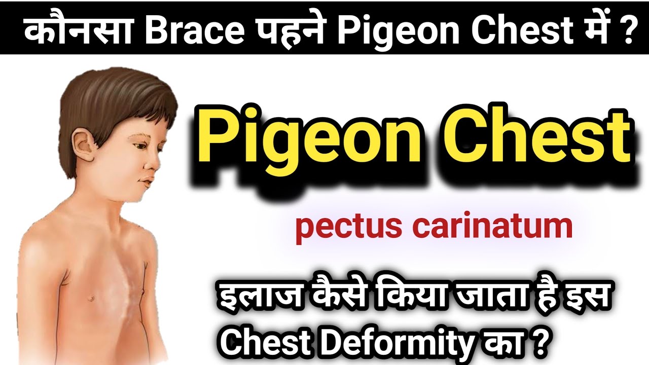 Pigeon Chest | pectus carinatum | pigeon chest Treatment in Hindi