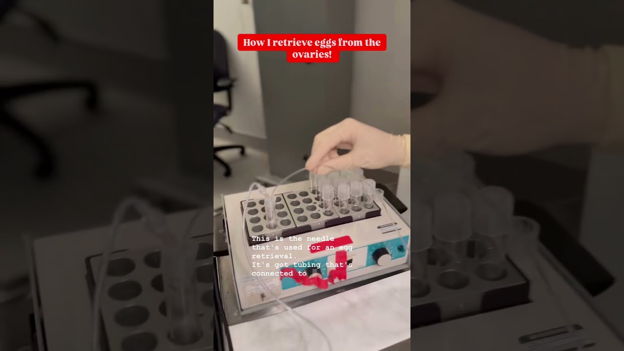 Как происходит забор яйцеклеток во время ЭКО (экстракорпорального оплодотворения)