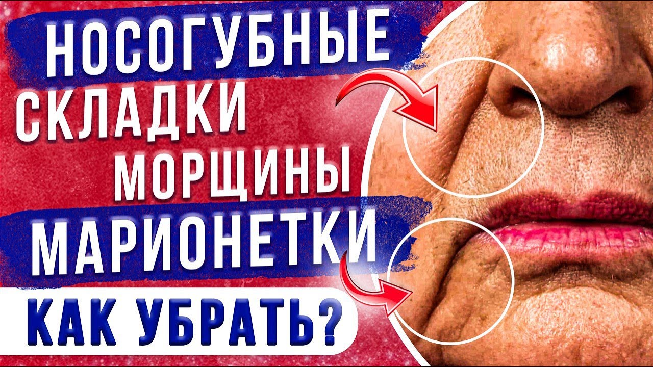 Носогубные складки и морщины марионетки. Что с ними делать?