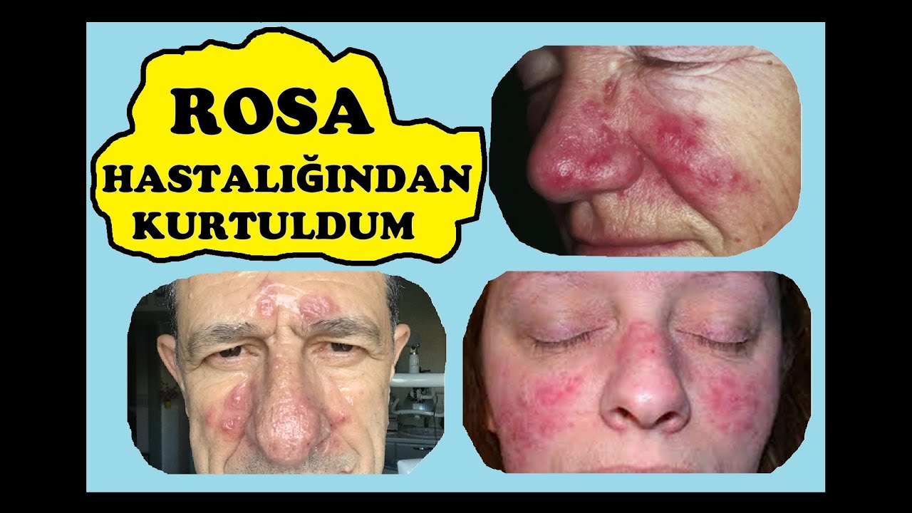 Rosa Hastalığından, Gül Hastalığından, Rosacea Hastalığından Kurtuldum.