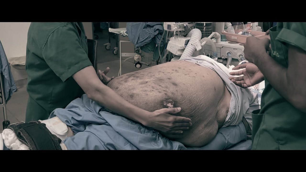 My Transplant story | MANOJ KUMAR | #TheBetterTransplant