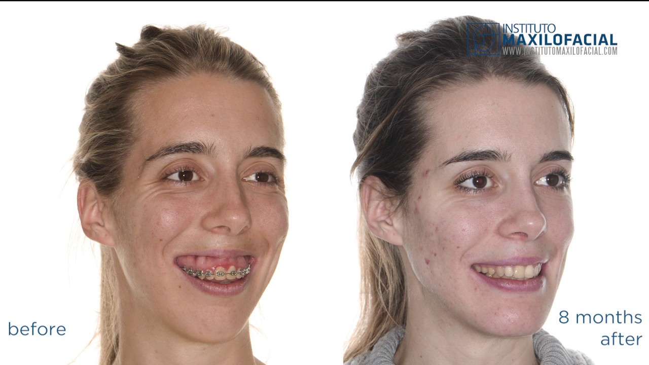MARINA: Class II, gummy smile, long face - Bimaxillary surgery, mentoplasty