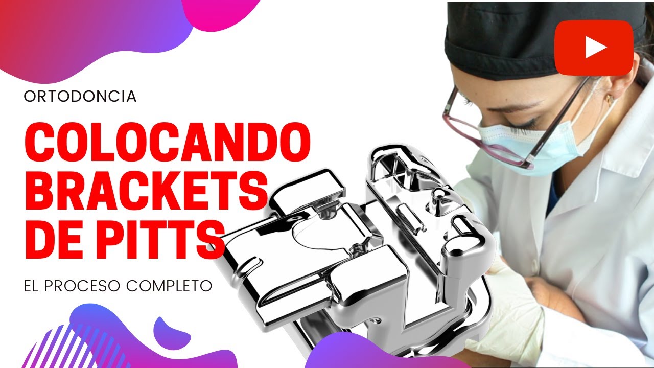 COLOCANDO BRACKETS DE PITTS... PROCESO COMPLETO.