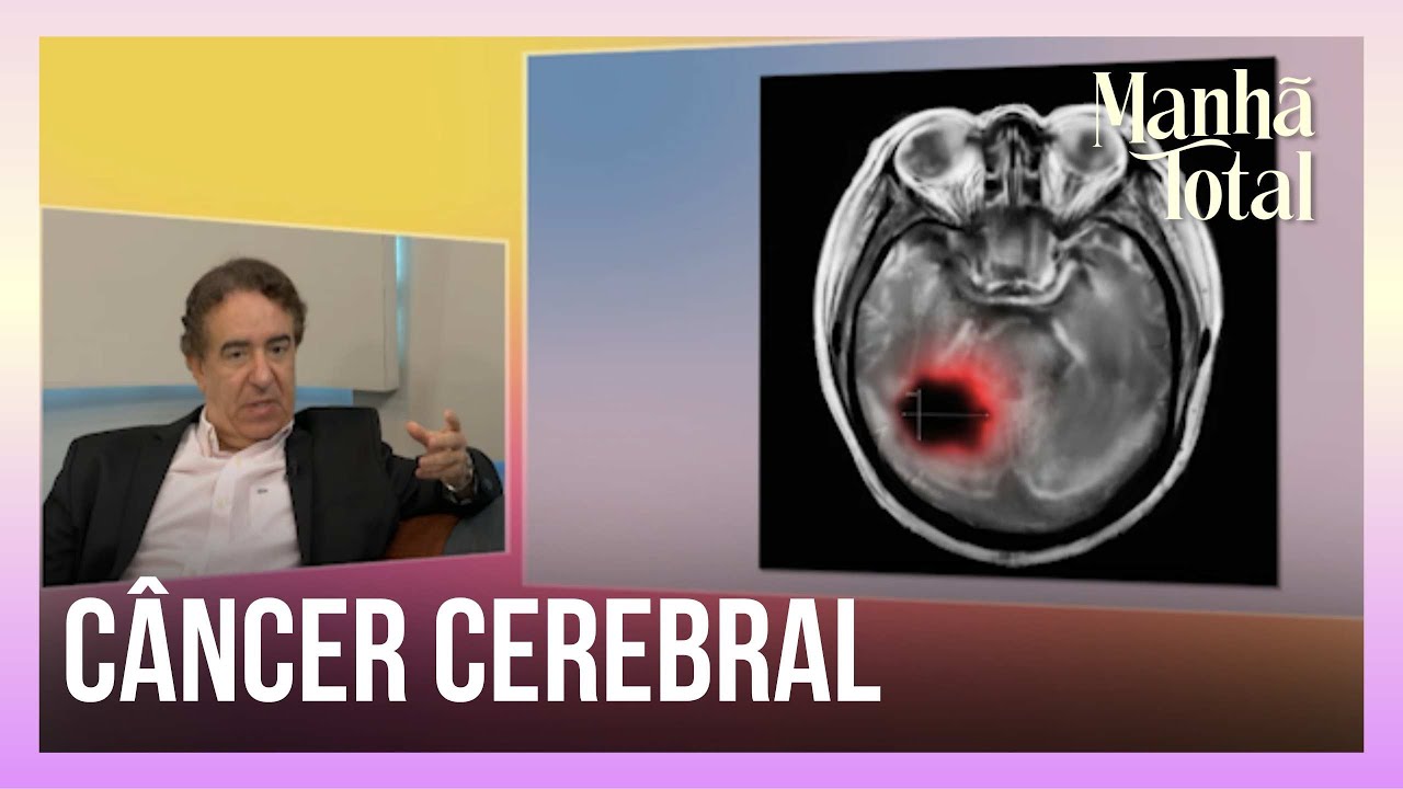 Médico explica sobre a prevenção e o diagnóstico precoce do câncer cerebral | Manhã Total
