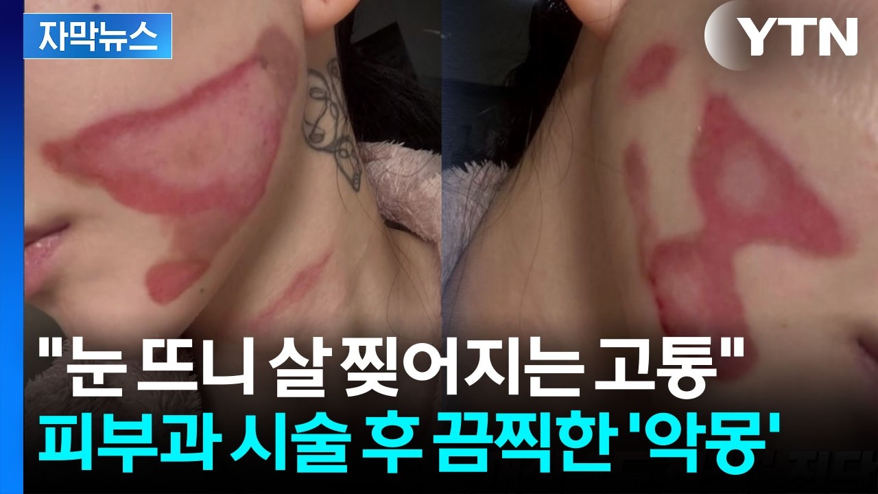 [자막뉴스] 얼굴 양쪽 심각한 상태...한예슬 이어 AOA 권민아도 '의료사고' / YTN