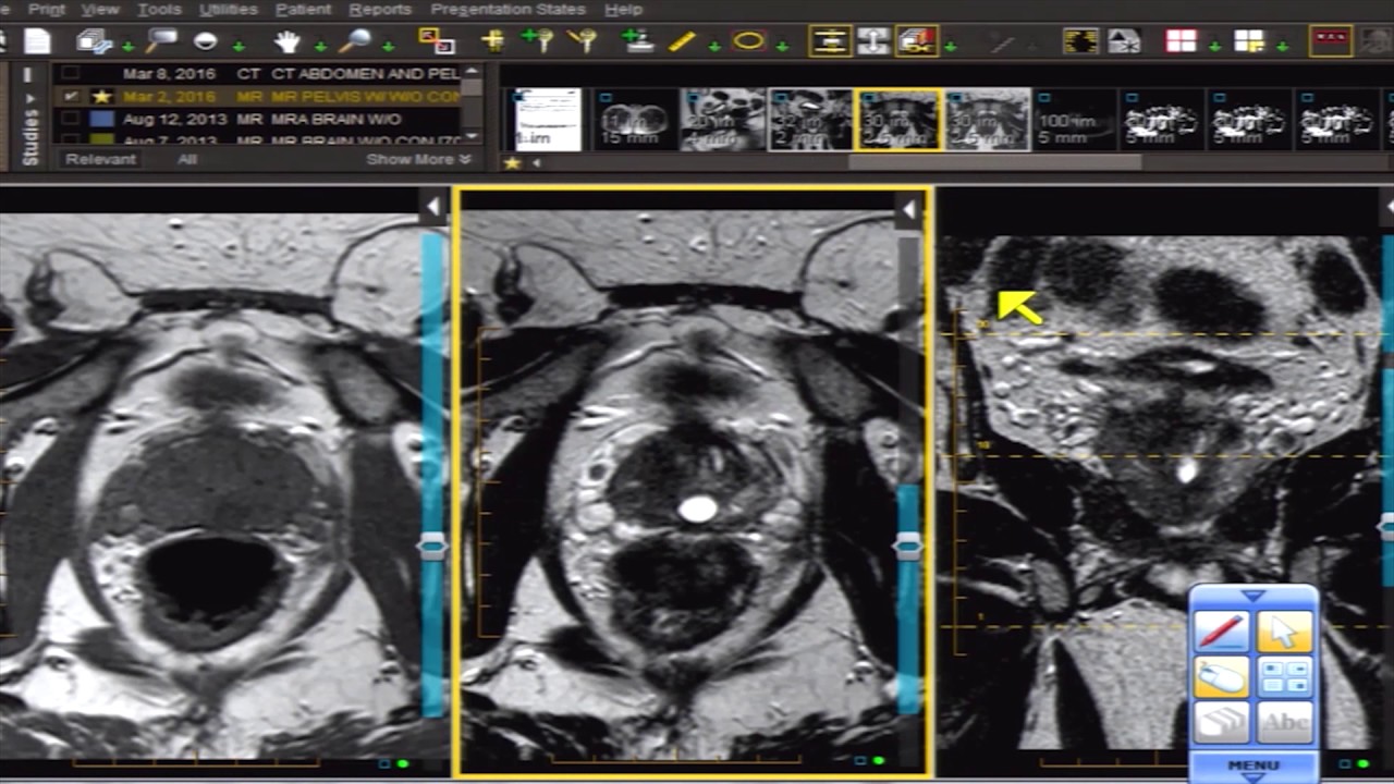 Prostate Carcinoma in Right Side of Gland on MRI