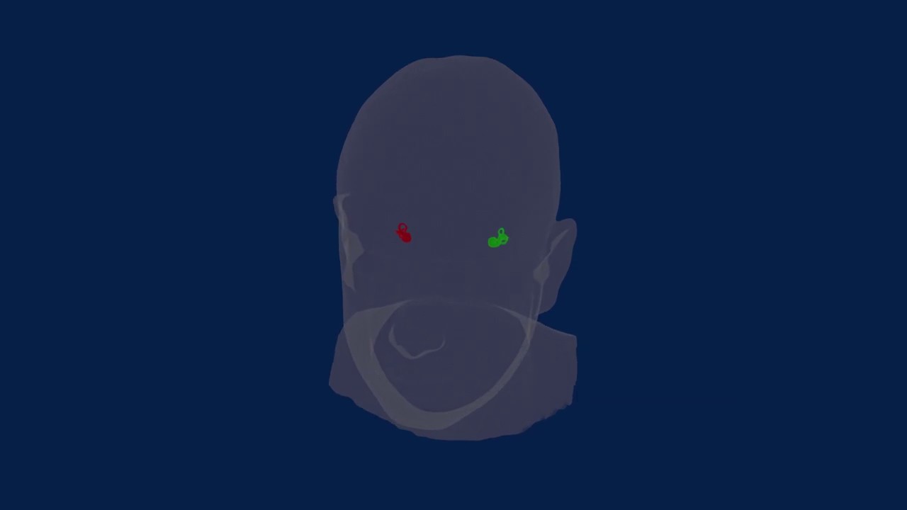 Bilateral Vestibular Loss (BVL)