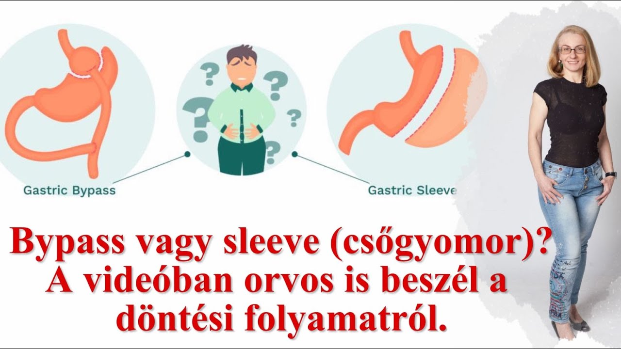 76. rész: Sleeve kontra bypass - melyik műtétet válasszam?
