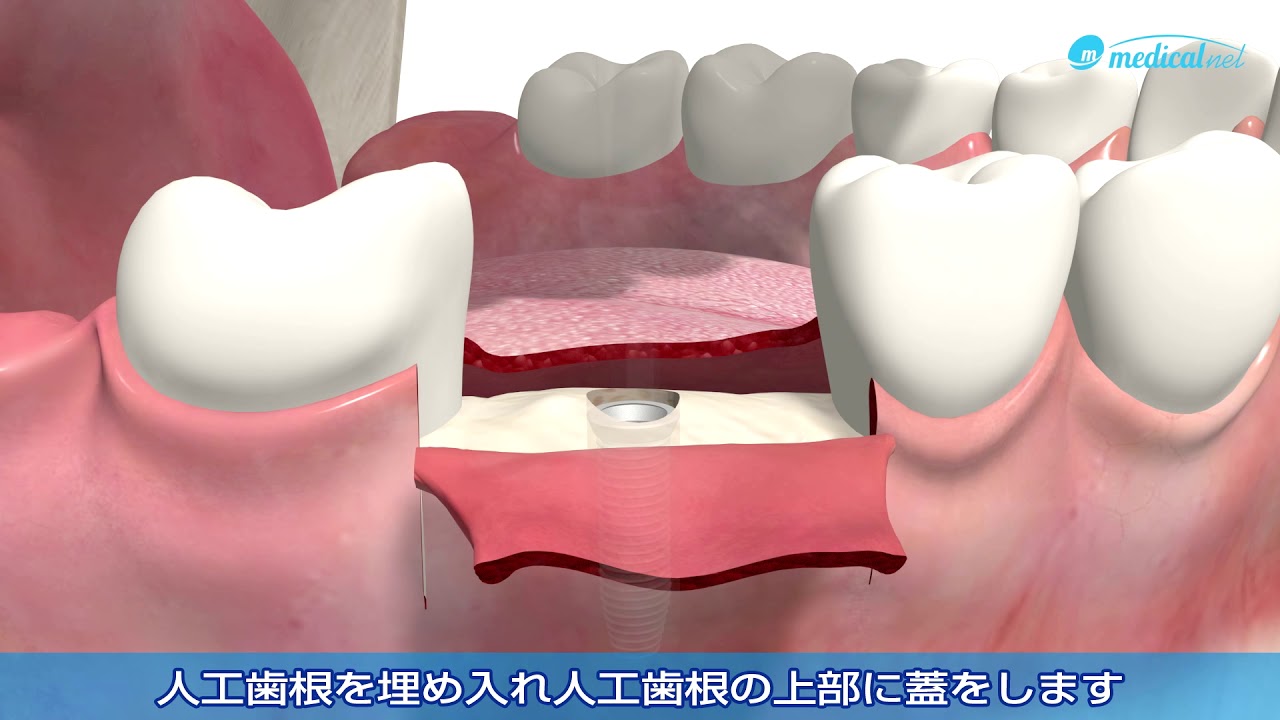 ３D動画で見るデンタルインプラント治療の流れ「インプラントを奥歯に一本埋め入み」