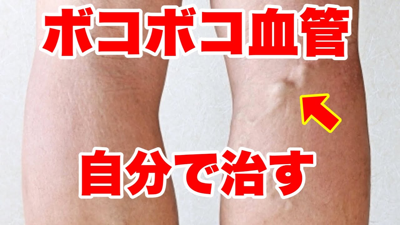 【静脈瘤】足のボコボコ血管を自分で治す方法