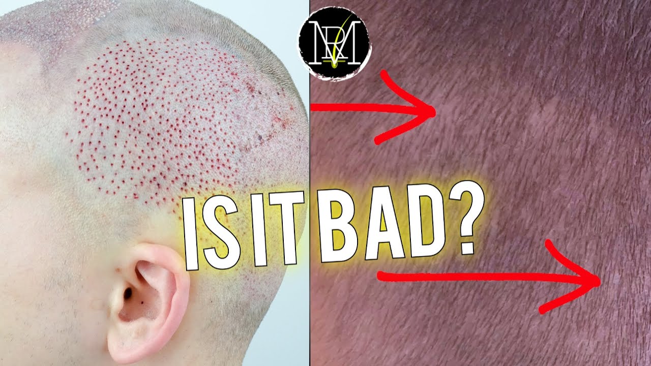 3500 grafts 18 weeks FUE Hair Transplant