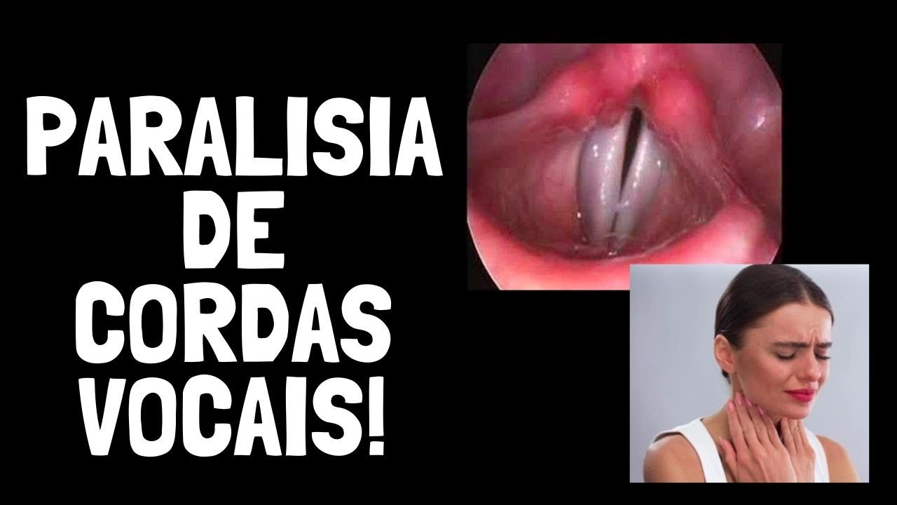 TUDO sobre PARALISIA DE CORDAS VOCAIS! Saiba as CAUSAS, as COMPLICAÇÕES e os TRATAMENTOS!
