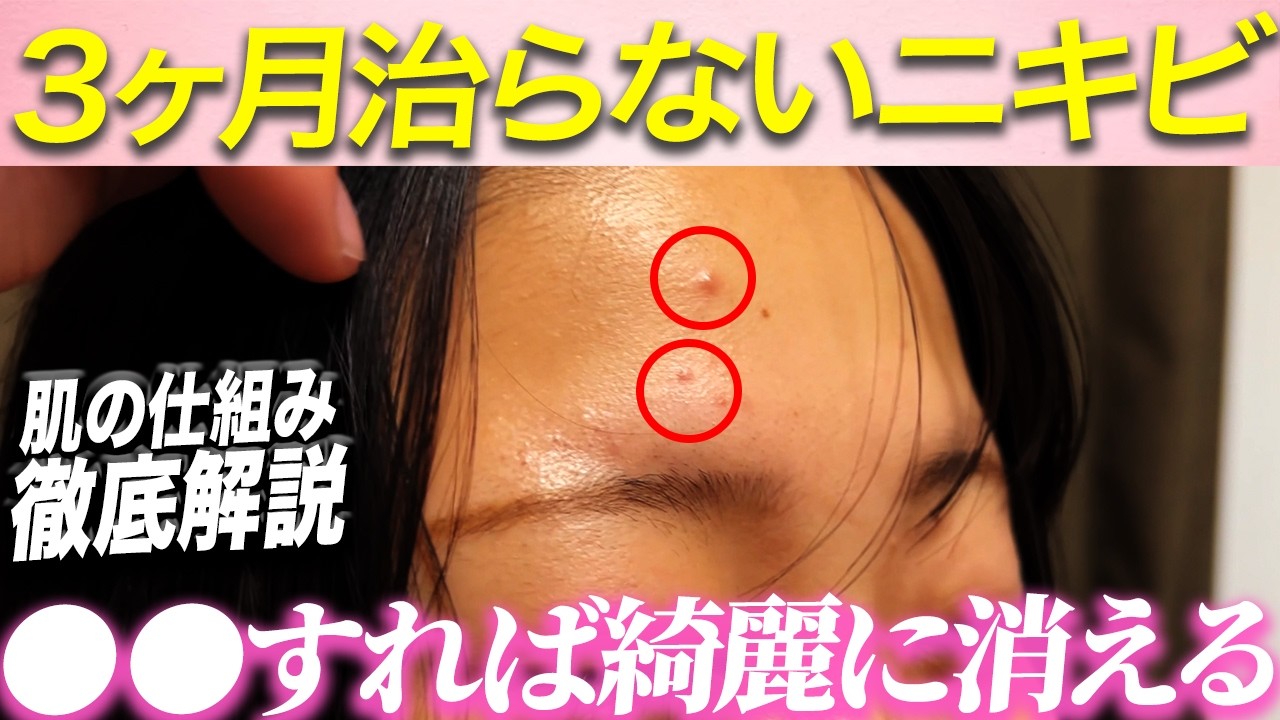 何度も再発するニキビの原因は何！？根本原因の解説と鍼治療で解消！