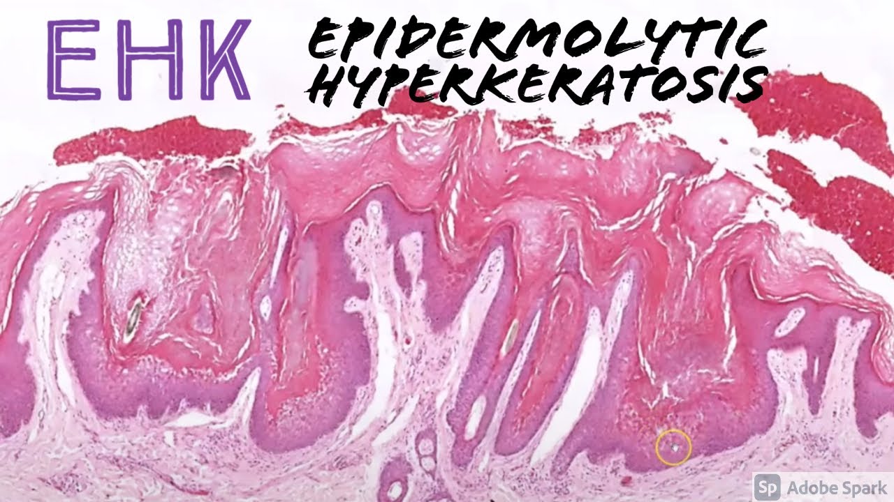 Epidermolytic Hyperkeratosis (EHK): 5-Minute Pathology Pearls