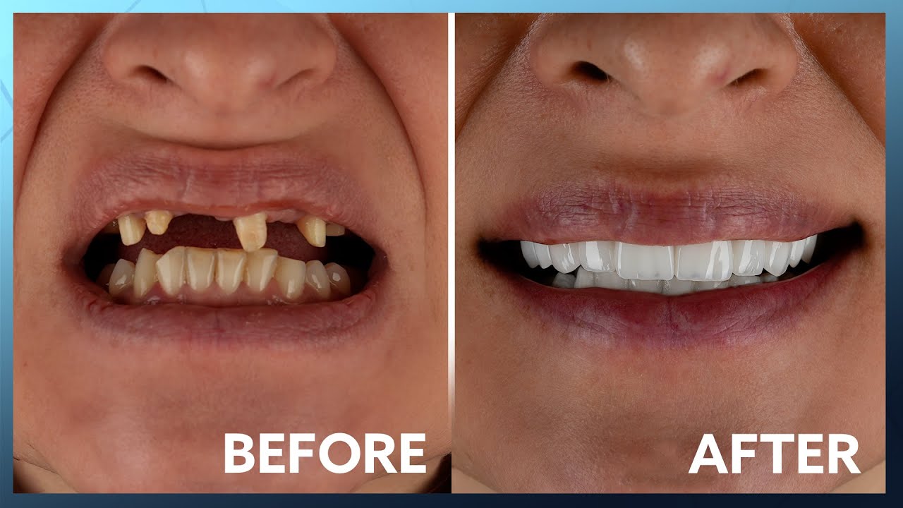 Unbelievable Smile Transformation: a New Yorker at Kristal Clinic
