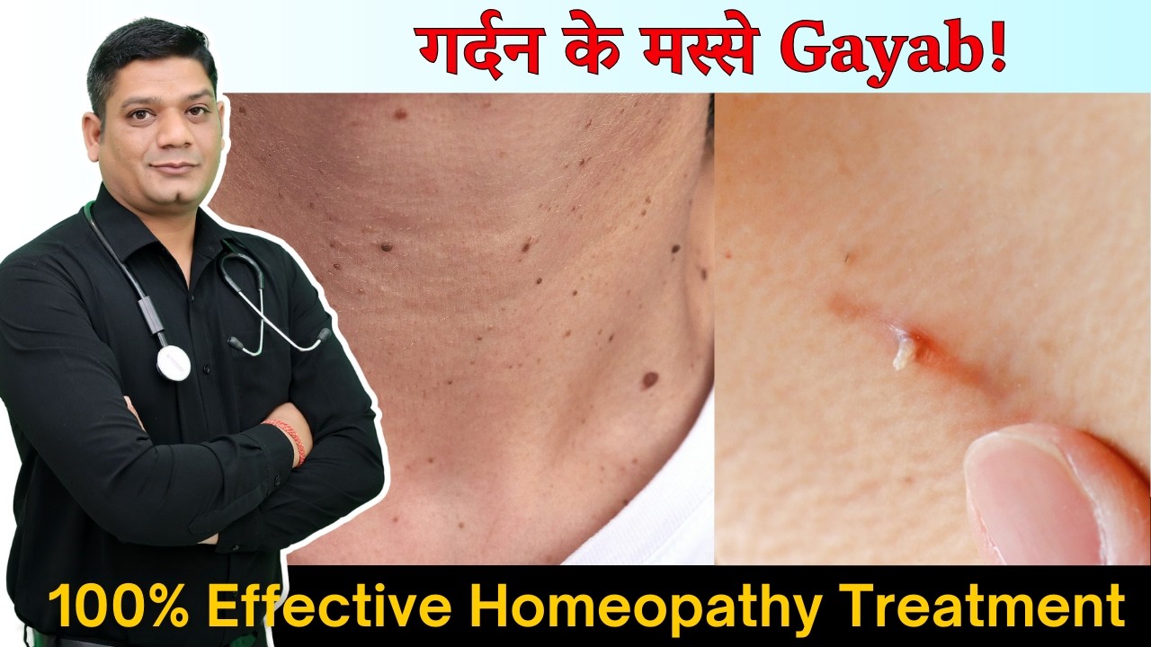 गर्दन के मस्से Gayab! 100% Effective Homeopathy Treatment for Neck Warts | Dr. Patidar #neckwarts