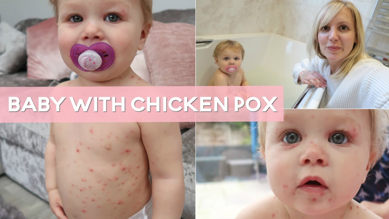 Day in the Life | Baby with Chicken Pox