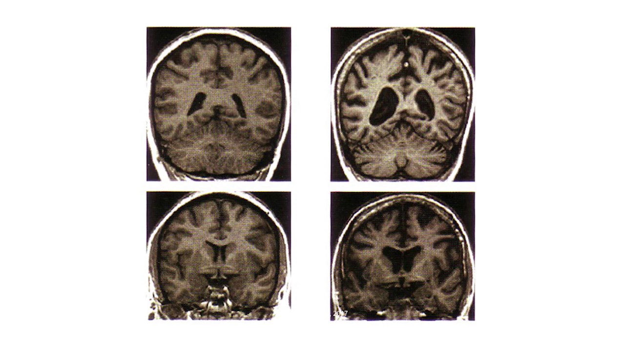The Neurobiology of Attachment