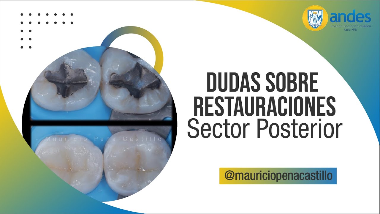 Resolviendo Dudas sobre Restauraciones en el Sector Posterior l ANDES DTC